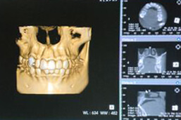 歯科用CTとオペ室で、安全・安心のインプラント治療を実現_1